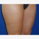 Korrektur mit Eigenfetttransplantation: Abbildung 12| nachher