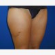 Korrektur mit Eigenfetttransplantation: Abbildung 11| vorher