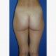 Fettabsaugen (Liposuktion / Liposculpture): Abbildung 2| nachher