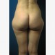 Fettabsaugen (Liposuktion / Liposculpture): Abbildung 1| vorher