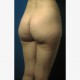 Fettabsaugen (Liposuktion / Liposculpture): Abbildung 3| vorher