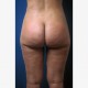 Fettabsaugen (Liposuktion / Liposculpture): Abbildung 6| nachher