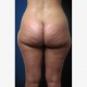Fettabsaugen (Liposuktion / Liposculpture): Abbildung 5| vorher