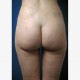 Fettabsaugen (Liposuktion / Liposculpture): Abbildung 8| nachher
