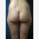 Fettabsaugen (Liposuktion / Liposculpture): Abbildung 7| vorher