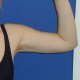 Liposuktion Oberarm: Abbildung 2| nachher