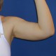 Liposuktion Oberarm: Abbildung 1| vorher