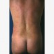 Fettabsaugen (Liposuktion / Liposculpture): Abbildung 2| nachher