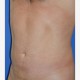 Fettabsaugen (Liposuktion / Liposculpture): Abbildung 4| nachher