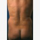 Fettabsaugen (Liposuktion / Liposculpture): Abbildung 1| vorher