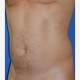 Fettabsaugen (Liposuktion / Liposculpture): Abbildung 3| vorher