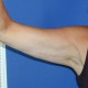 Oberarmstraffung: Abbildung 4| nachher