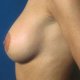 Brustvergrösserung: Abbildung 8| nachher