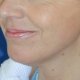 Facelifting, Gesichtsstraffung: Abbildung 2| nachher