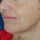 Facelifting, Gesichtsstraffung: Abbildung 1| vorher