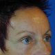 Stirnlifting: Abbildung 2| nachher