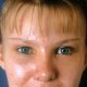 Stirn- und Wangenlifting: Abbildung 4| nachher