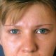 Stirn- und Wangenlifting: Abbildung 3| vorher