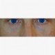 Laser Behandlung: Abbildung 2| nachher