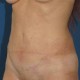Abdominoplastik Abbildung 6| nachher