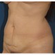 Abdominoplastik Abbildung 5| vorher