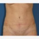 Abdominoplastik Abbildung 8| nachher
