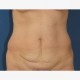 Abdominoplastik Abbildung 7| vorher