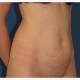 Abdominoplastik Abbildung 9| vorher