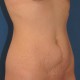 Abdominoplastik Abbildung 11| vorher